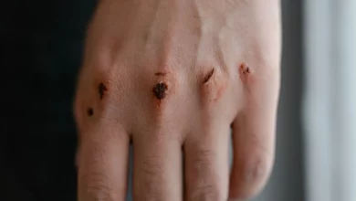 جرح اليد في المنام