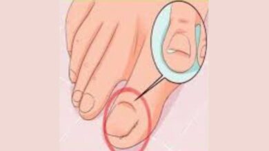 الاصبع الغائر